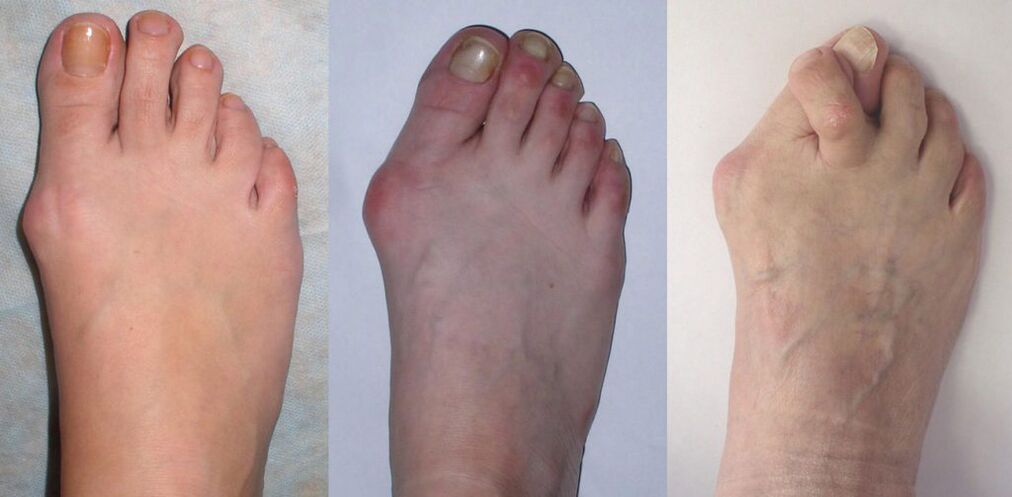 Artritis stopala