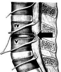 X -Ray Slika lumbalnog odjela za osteohondrozu
