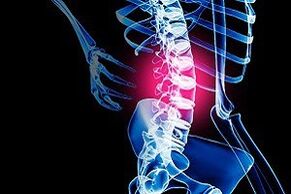 osteohondroza lumbalne kralježnice