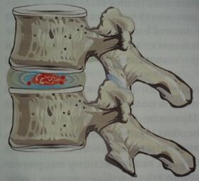 Prva faza osteohondroze