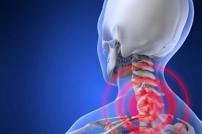 Probijajuća bol u vratu rani je simptom cervikalne osteohondroze